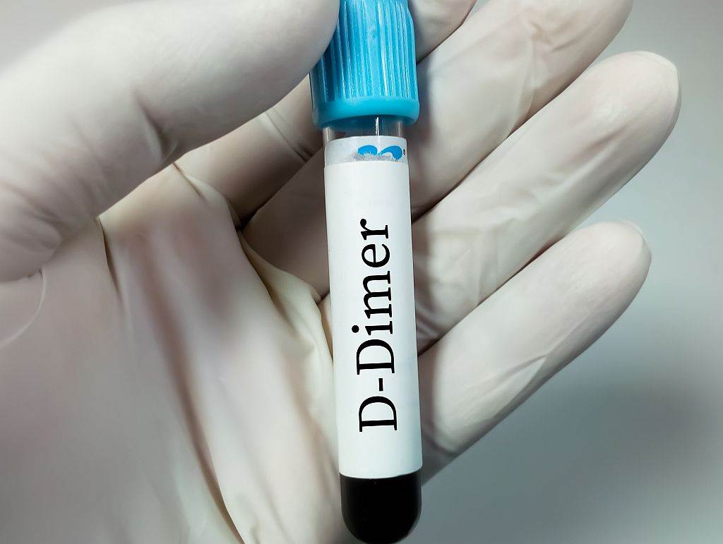 Šta je i na šta ukazuje povišeni Ddimer /VIDEO/ NTV Arena